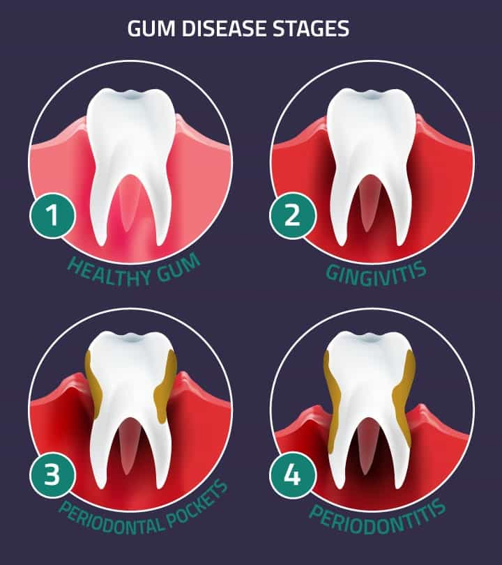 Gum Disease Treatment: Periodontitis Treatment in Colorado Springs