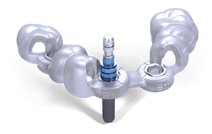 Dental Implant Surgical Guide 3D CT