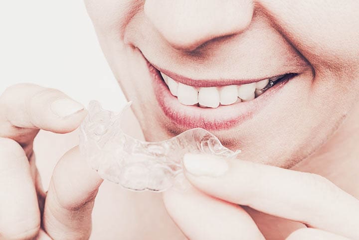 Transparent ClearCorrect Aligners aka clear braces