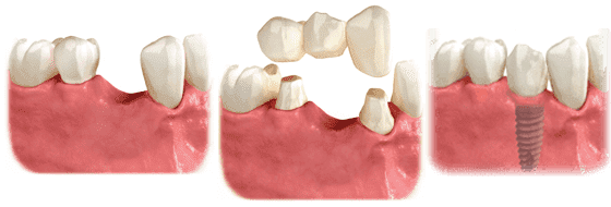 single tooth implant