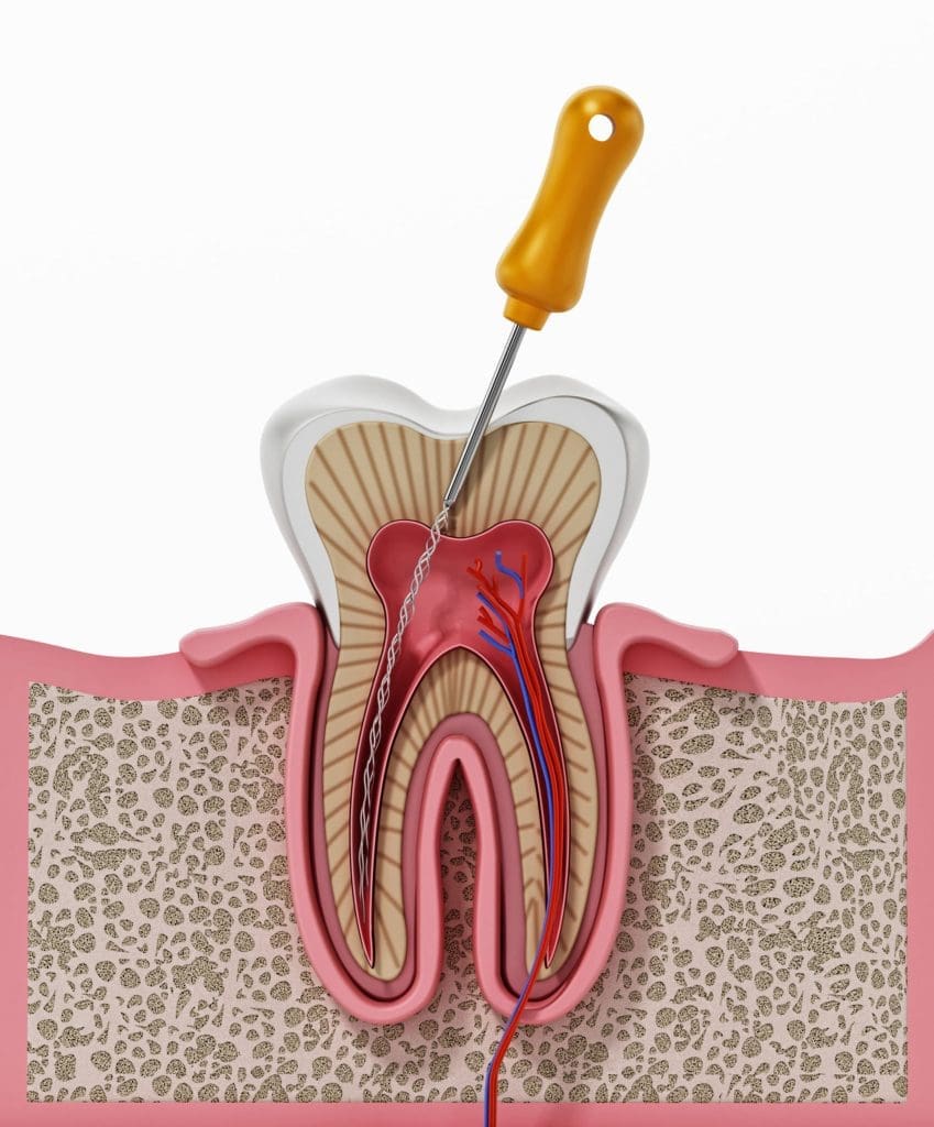 Root Canal Colorado Springs