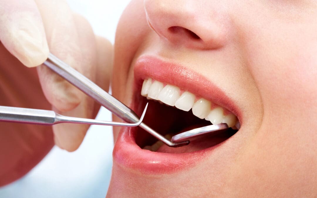 4 Types Of Fillings | 719-447-1199 | One Stop Dental