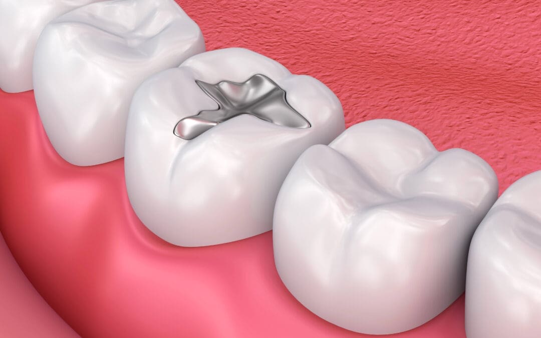 Mercury Fillings | 719-447-1199 | One Stop Dental