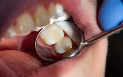 What Does A Filled Cavity Look Like?