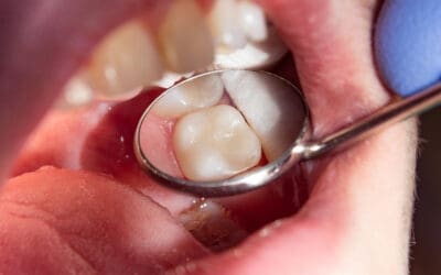 What Does A Cavity Filling Look Like?