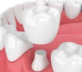 Affordable Dental Crown Options: High-Quality Restorations Within Reach