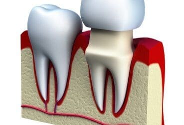 Natural-Looking Tooth Caps: Smile Without Compromise