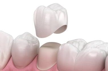Single-Visit Crown Placement: Convenience Without Sacrificing Quality