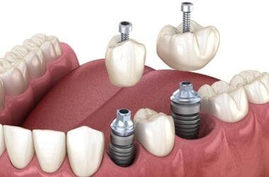 Dental Crown for Cracked Tooth: Protect and Preserve