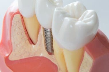 Long-Lasting Dental Crown Solutions: Invest in Your Smile