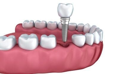 Custom Crowns for Damaged Teeth: Precision Meets Comfort